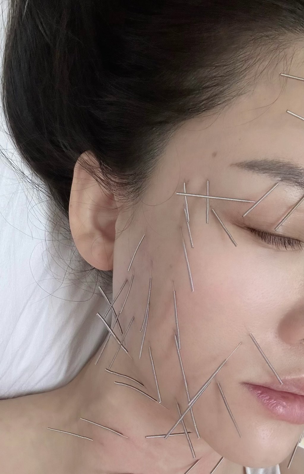 Pain in the neck: Joe Chen Chiao-en had scores of needles pushed into her skin. Photo: Handout Pain in the neck: Joe Chen Chiao-en had scores of needles pushed into her skin. Photo: Handout