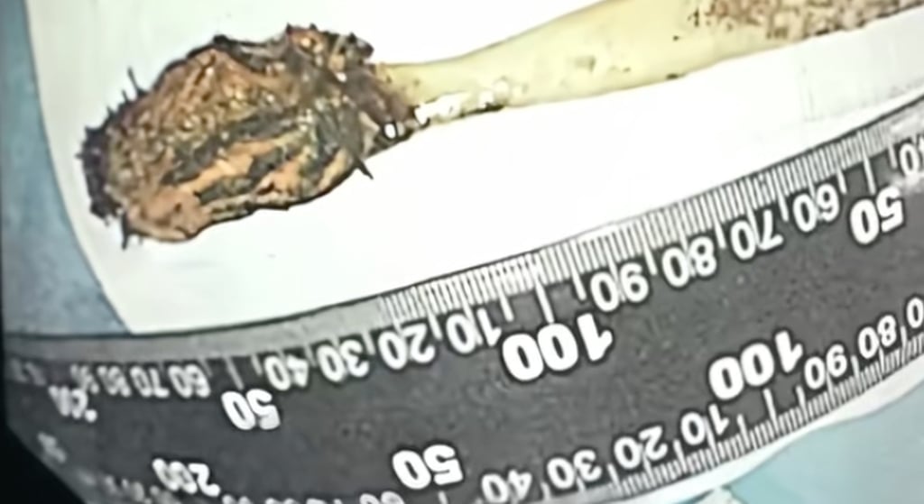 Despite the toothbrush being inside his body for many years, the man said he had not felt anything untoward until recently. Photo: handout Despite the toothbrush being inside his body for many years, the man said he had not felt anything untoward until recently. Photo: handout