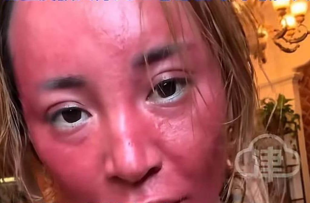 The woman’s face is now severely inflamed, characterised by pronounced redness, and covered in dense rashes. Photo: Weibo The woman’s face is now severely inflamed, characterised by pronounced redness, and covered in dense rashes. Photo: Weibo
