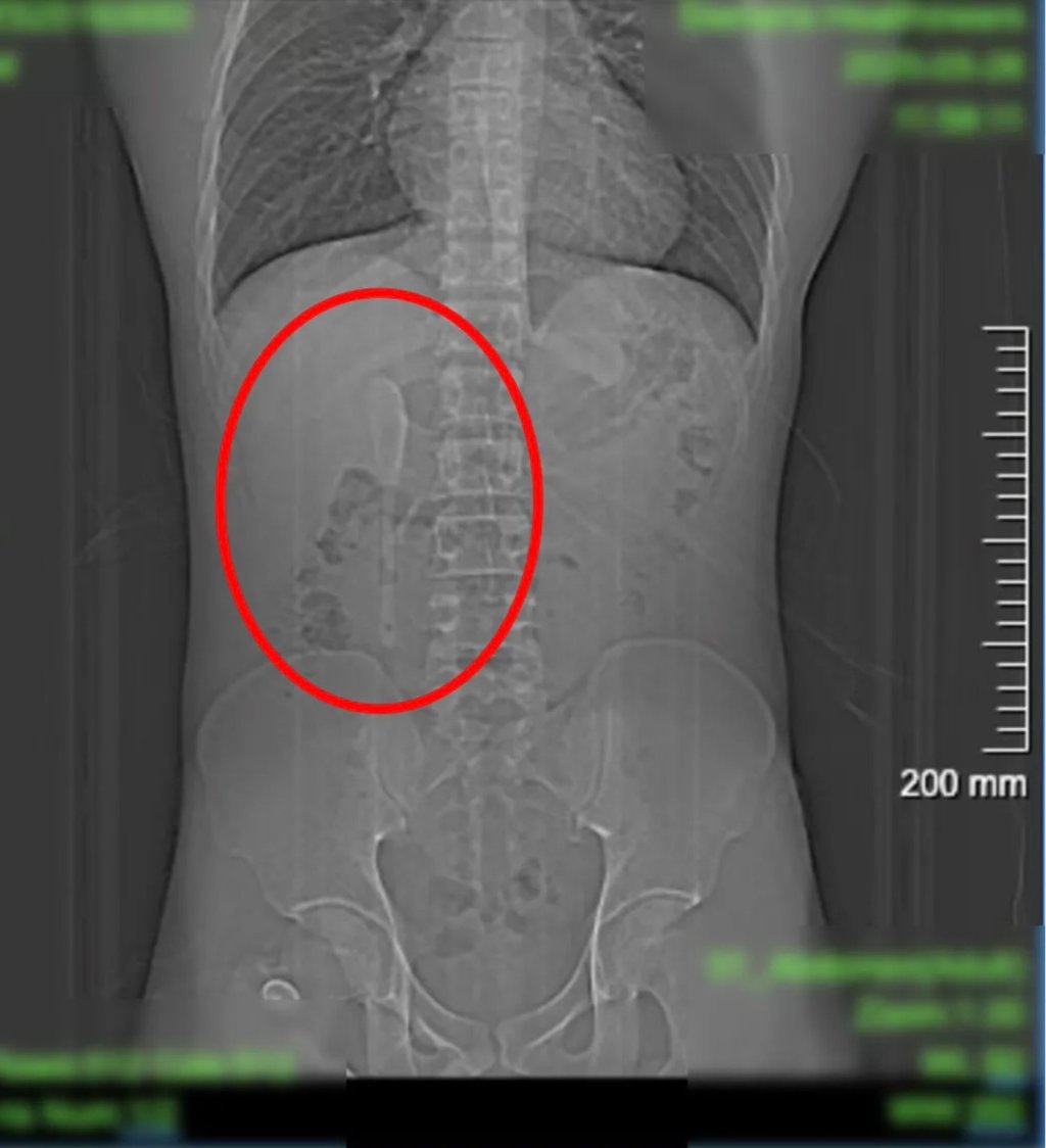 The spoon became lodged in his duodenum, the initial section of the small intestine. Photo: QQ.com