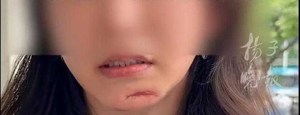 According to doctors, Ding’s unsightly scar resulted from “mistaken and dangerous” advice she was given. Photo: Douyin According to doctors, Ding’s unsightly scar resulted from “mistaken and dangerous” advice she was given. Photo: Douyin