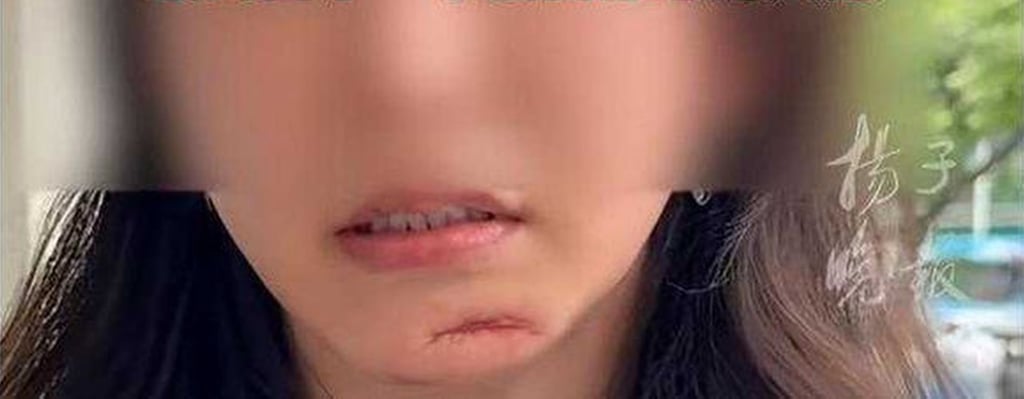 According to doctors, Ding’s unsightly scar resulted from “mistaken and dangerous” advice she was given. Photo: Douyin