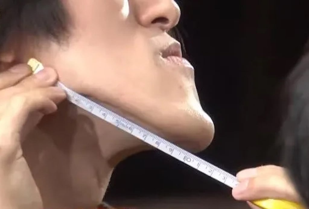 Doctors told the Japanese online sensation that they “had never seen such a chin”. Photo: QQ.com