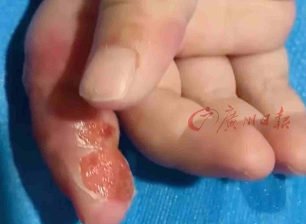 Little Lele’s index finger became swollen and discoloured as a result of her mother wrapping it up. Photo: Sina