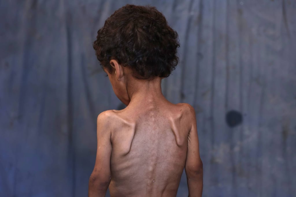 A malnourished two-year-old Palestinian boy in Gaza. Photo: AFP