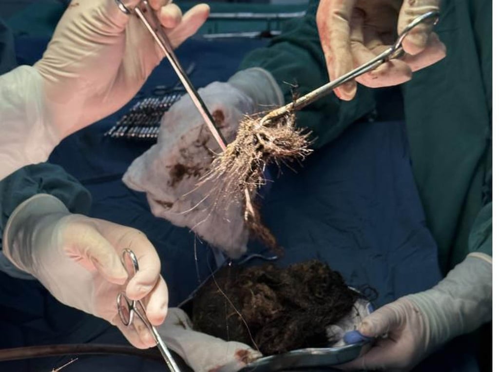 Surgeons removed many clumps of hair mixed with food residue from the teenager’s stomach. Photo: Douyin