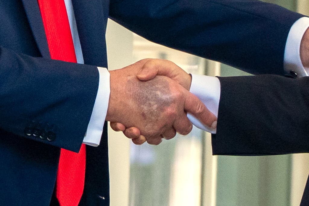 US President Donald Trump’s bruised hand on August 25. Photo: AP US President Donald Trump’s bruised hand on August 25. Photo: AP