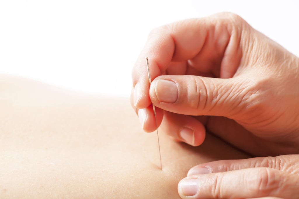 While not a universal cure, Chinese acupuncture effectively treats various pain types, including migraines and osteoarthritis. Photo: Shutterstock