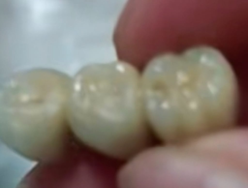 On October 13, a woman in northeastern China’s Jilin province reported discovering a row of three artificial human teeth in a sausage she had bought for her child. Photo: Weibo On October 13, a woman in northeastern China’s Jilin province reported discovering a row of three artificial human teeth in a sausage she had bought for her child. Photo: Weibo