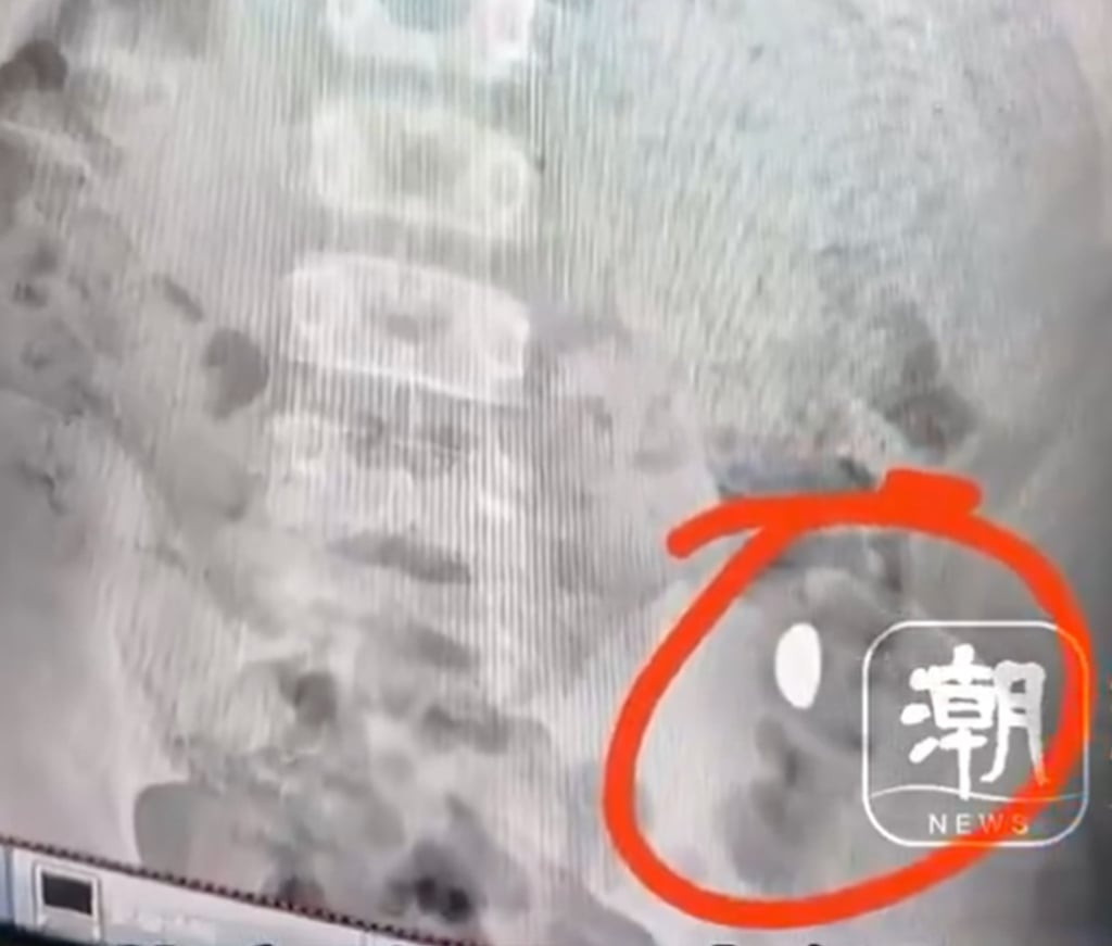 An X-ray taken in hospital shows the gold bean lodged in the boy’s stomach. Photo: Baidu