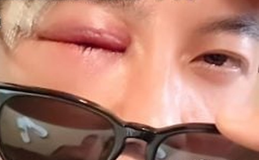 Zhao Honggang shows off the injuries he suffered in the slapping competition. Photo: RedNote Zhao Honggang shows off the injuries he suffered in the slapping competition. Photo: RedNote