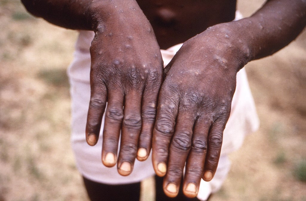 Mpox is a viral infection related to smallpox, causing fever, body aches and distinct skin lesions, and can be deadly. Photo: AP Mpox is a viral infection related to smallpox, causing fever, body aches and distinct skin lesions, and can be deadly. Photo: AP