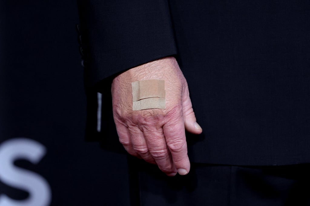US President Donald Trump’s bandaged hand on December 7. Photo: Reuters US President Donald Trump’s bandaged hand on December 7. Photo: Reuters