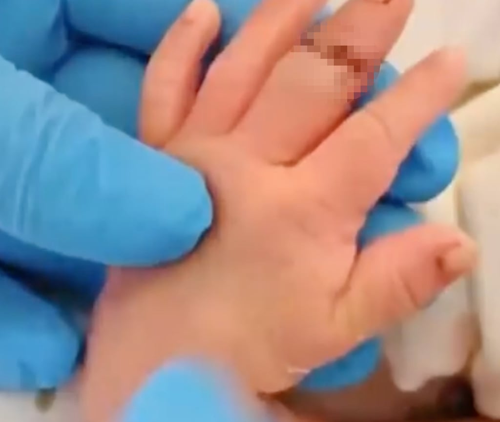 The newborn baby’s finger after surgery. He had to be transferred to two hospitals before an operation could be performed. Photo: Sohu The newborn baby’s finger after surgery. He had to be transferred to two hospitals before an operation could be performed. Photo: Sohu