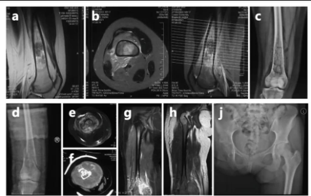 In 2023 and 2024, her cancer returned, spreading to her lungs, and she recently revealed a new tumour in her pleura. Photo: QQ.com In 2023 and 2024, her cancer returned, spreading to her lungs, and she recently revealed a new tumour in her pleura. Photo: QQ.com