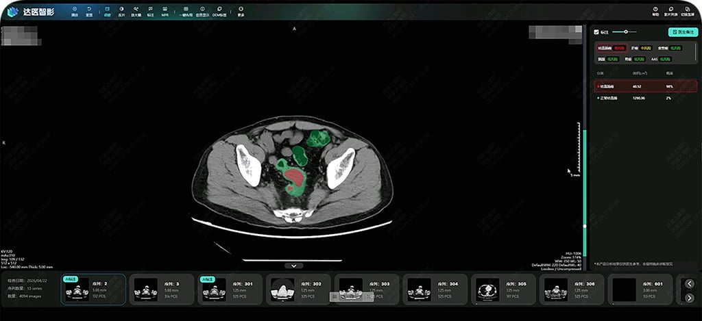 Damo Academy said its Coca AI model has higher sensitivity in detecting colorectal cancer than radiologists. Photo: Handout