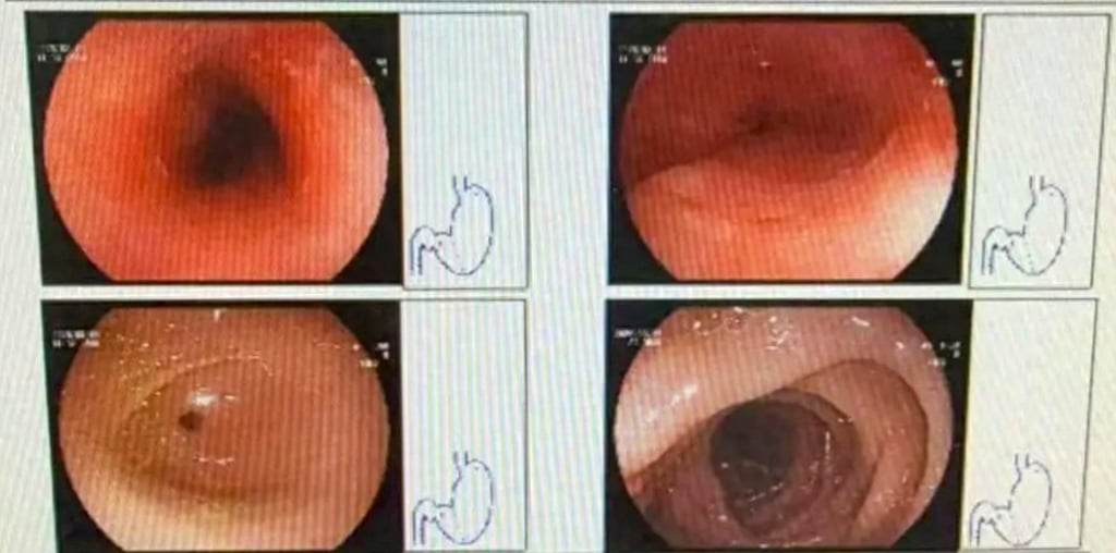 An endoscopy examination photograph shows the extent of the damage done to Wang. Photo: Sina An endoscopy examination photograph shows the extent of the damage done to Wang. Photo: Sina