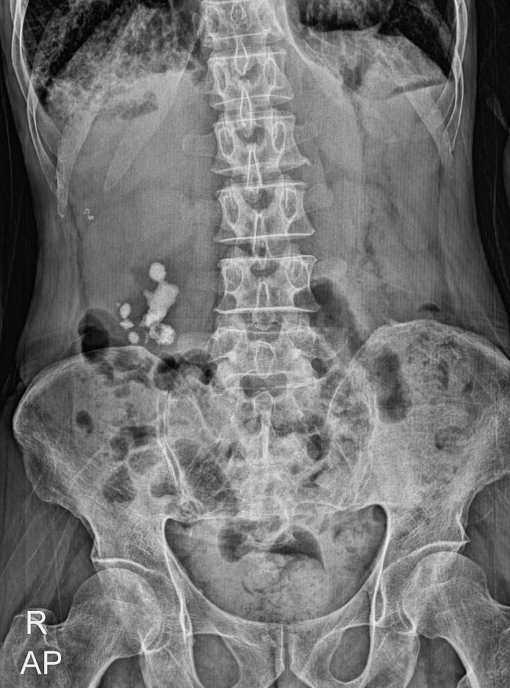 An X-ray of the urinary tract shows that the patient in a separate case has kidney stones in their right kidney. Photo: Shutterstock An X-ray of the urinary tract shows that the patient in a separate case has kidney stones in their right kidney. Photo: Shutterstock