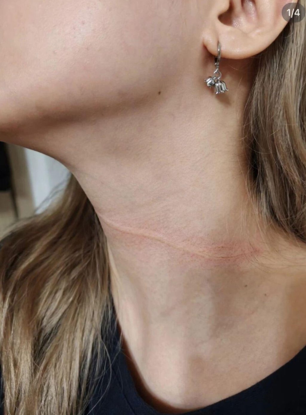 Wang was left with a lasting mark on her neck, above, as a result of the incident. Photo: myzaker