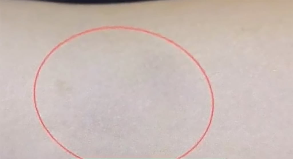 The above image, circled in red, shows the lump on Wang’s arm. Photo: Weibo