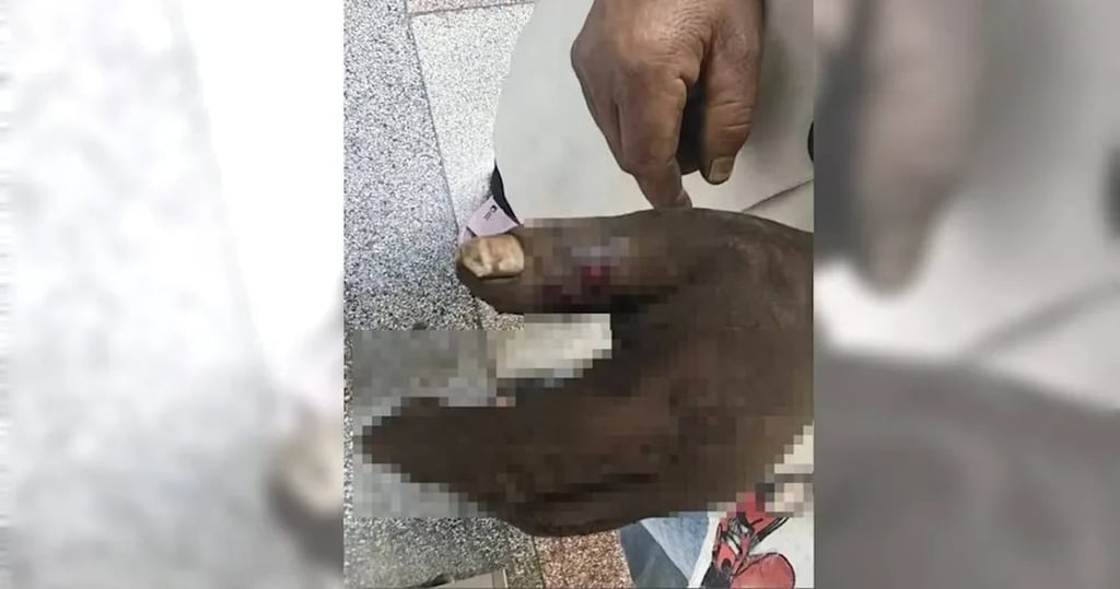 The husband’s wound quickly became swollen and darkened, leaving him feeling dizzy and weak. Photo: Handout The husband’s wound quickly became swollen and darkened, leaving him feeling dizzy and weak. Photo: Handout