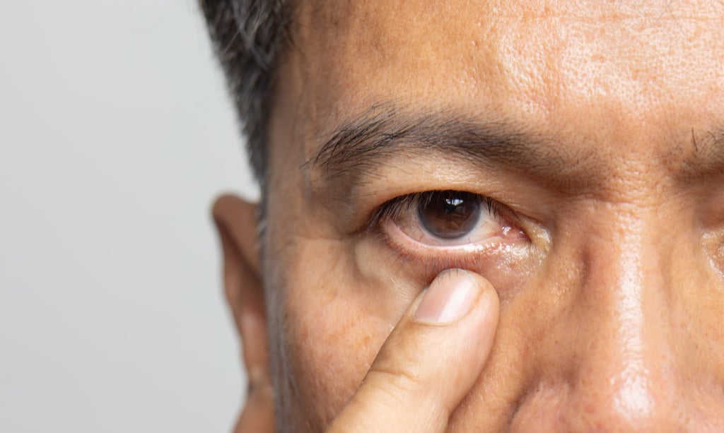 Some elderly locals in China believe that sticking a strip of white paper onto the eyelid halts the twitching. Photo: Shutterstock Some elderly locals in China believe that sticking a strip of white paper onto the eyelid halts the twitching. Photo: Shutterstock
