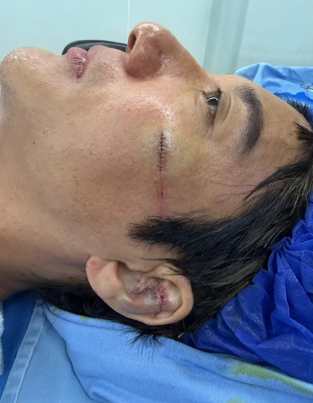 Showing off his battle scars, the singer posted images of his wounds, revealing he required 27 stitches to his ear and 12 to his face. Photo: Handout Showing off his battle scars, the singer posted images of his wounds, revealing he required 27 stitches to his ear and 12 to his face. Photo: Handout