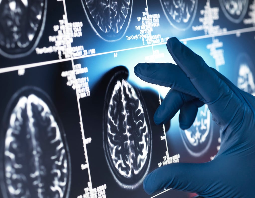 A doctor inspects a brain scan for signs of possible disease. Dementia is characterised by a build-up of toxic brain waste. Photo: Getty Images