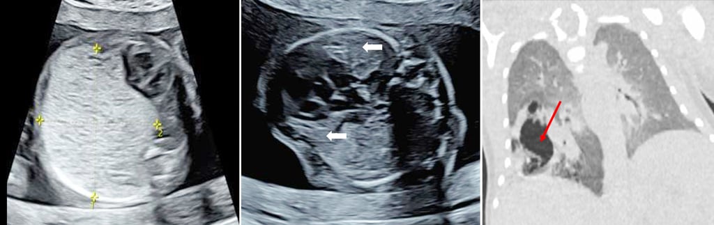 Guided by high-definition, real-time ultrasound imaging, the medical team precisely mapped a route to insert a fine ablation needle directly into the core of the tumour. Photo: Ultrasound in Obstetrics & Gynecology