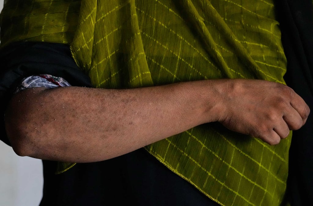 A factory worker shows her arm with damage she believes to be from routine chemical exposure in Karachi on October 4. Photo: AP
