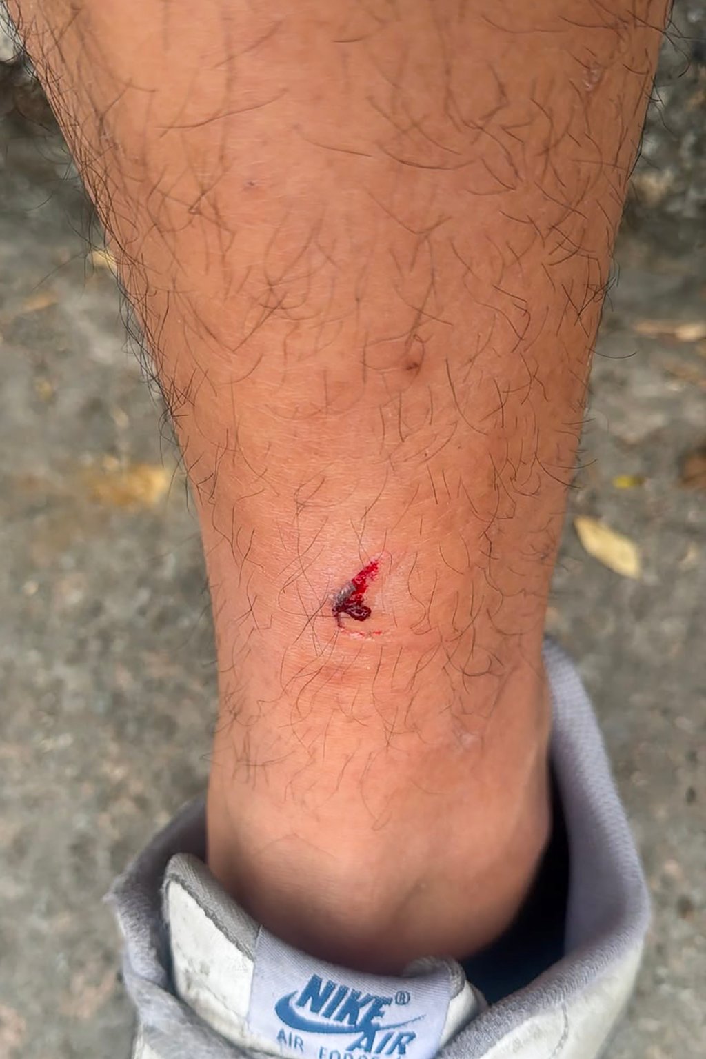 The man was bitten on the left shin. Photo: Handout The man was bitten on the left shin. Photo: Handout