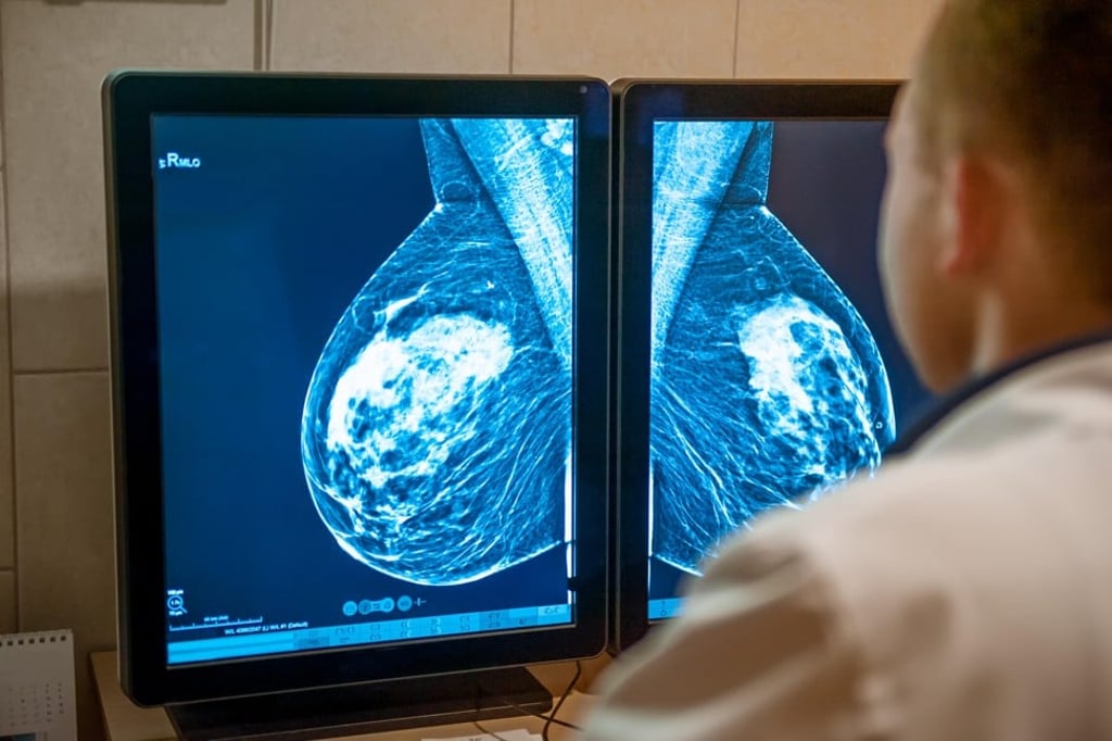 A doctor examines a mammogram. Photo: Alamy