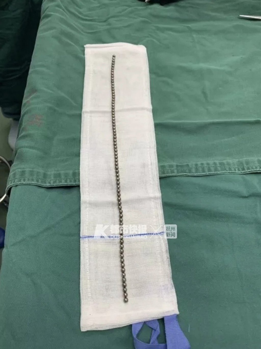 A surgeon at the hospital said the last few balls were pulled out in one line. Photo: Guancha