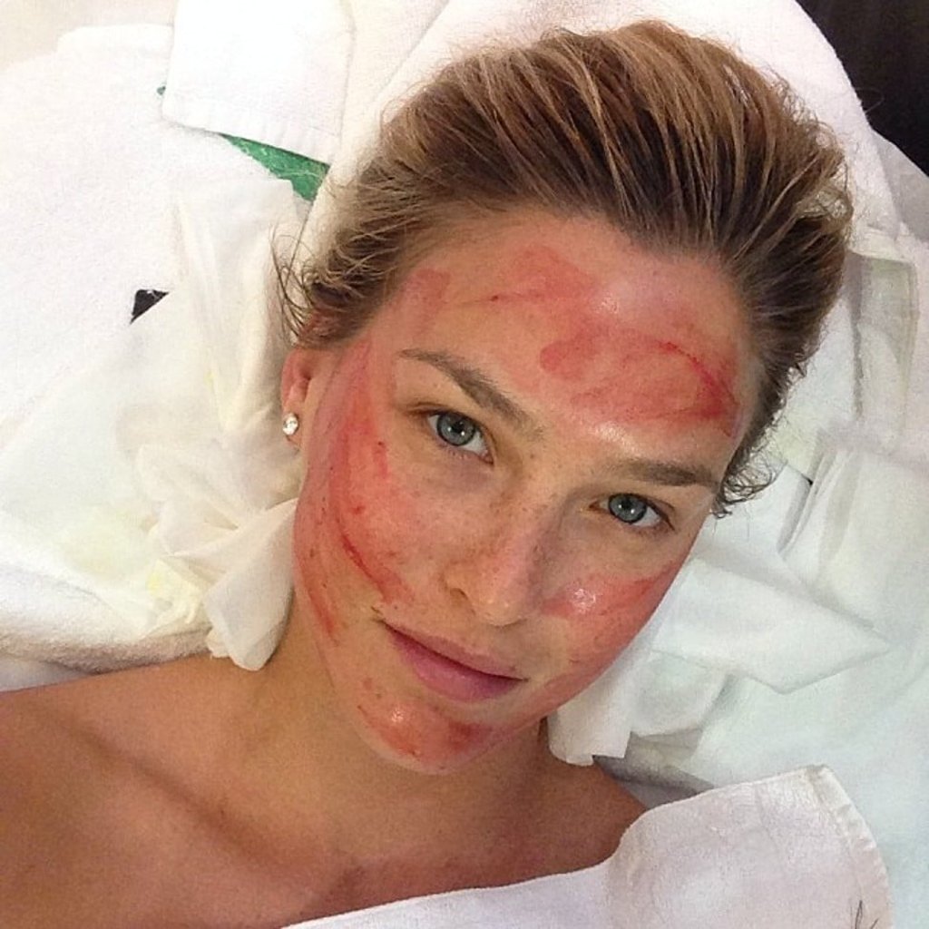 Supermodel Bar Rafaeli after a vampire facial. Supermodel Bar Rafaeli after a vampire facial.