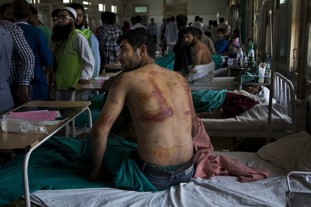 A Kashmiri man shows his injuries after allegedly being beaten up by Indian soldiers at Khrew village in Kashmir. Photo: AP
