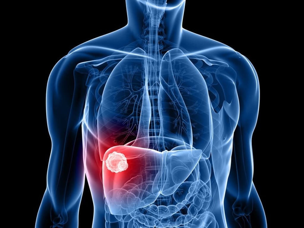 An image of liver cancer in the body. Photo: Alamy