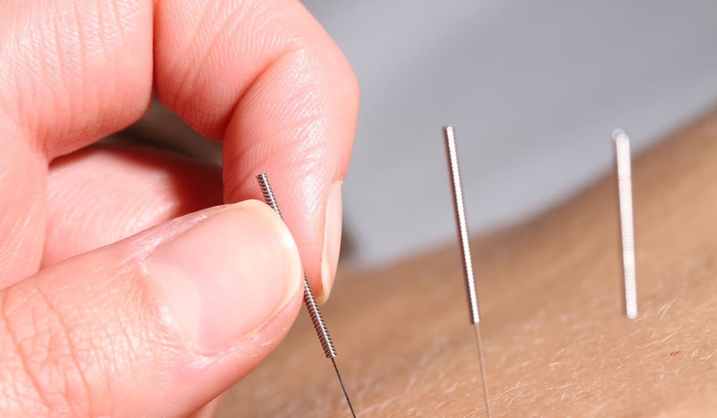 Alternative medicine and acupuncture is a great tool to supplement training, but no bio-hack is a quick fix to healthy living. Photo: Alamy