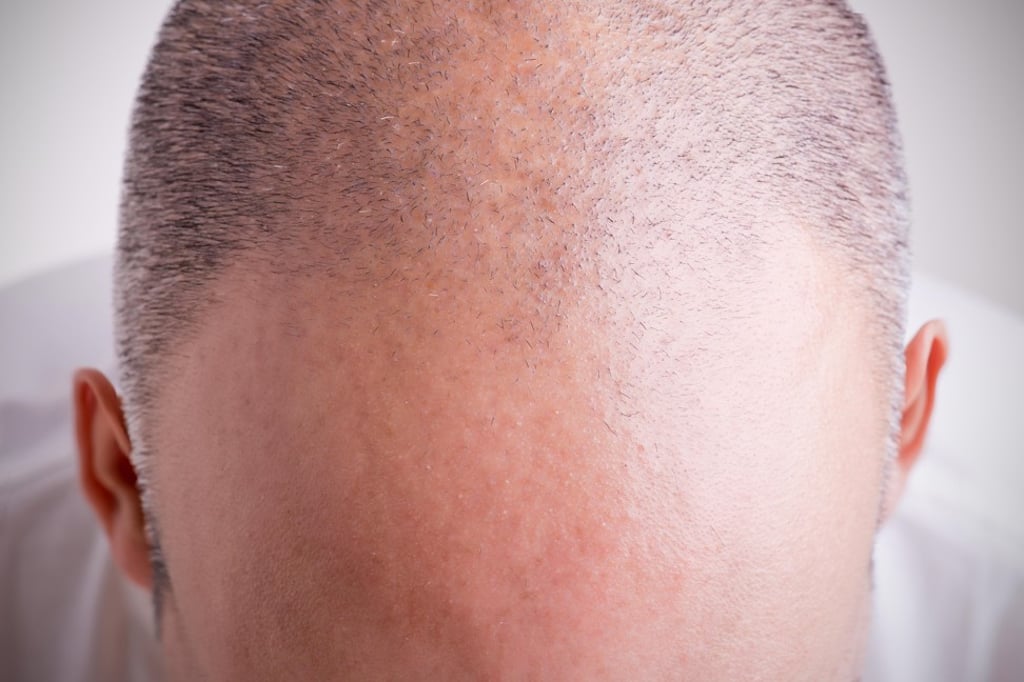 It may be considered intelligent and authoritative, but balding Chinese men are not happy with the look. Photo: Alamy