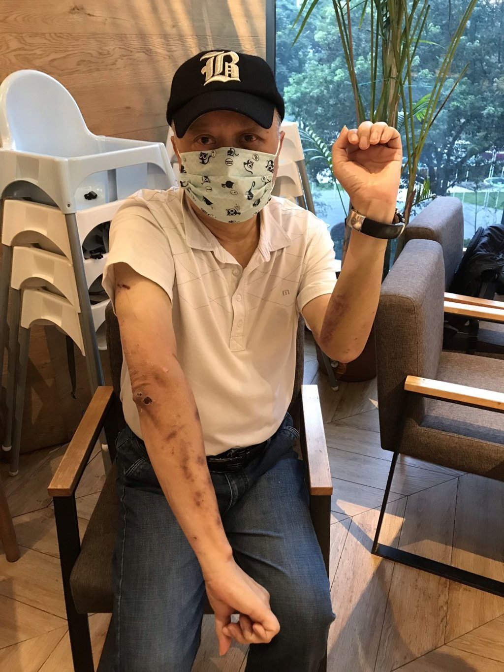 Henry Cheng Kwok-chuen shows some of his injuries during an interview with the Post. Photo: Cannix Yau Henry Cheng Kwok-chuen shows some of his injuries during an interview with the Post. Photo: Cannix Yau