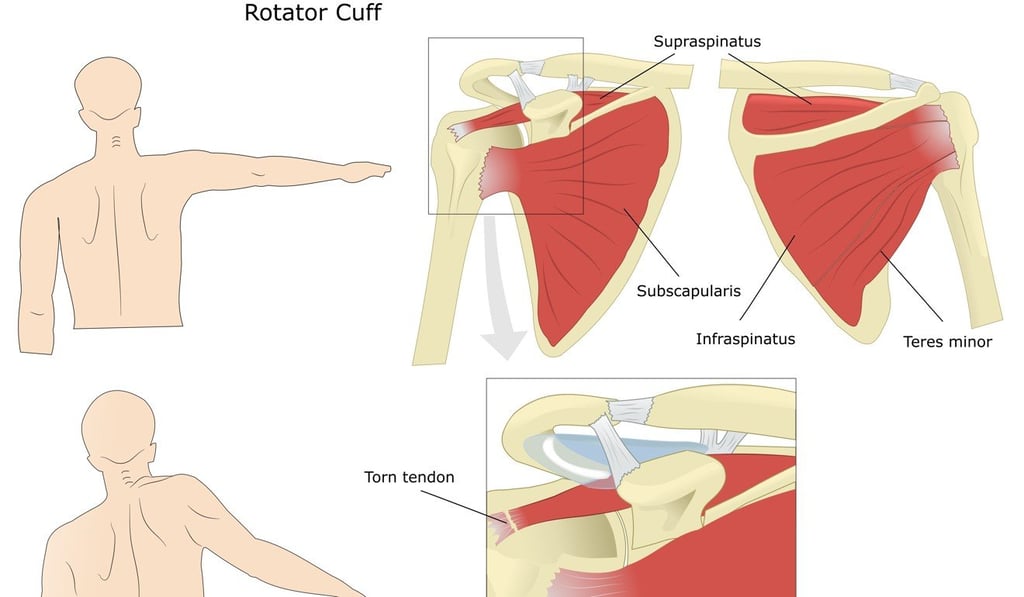 (Top) A normal rotator cuff – the four muscles that rotate the shoulder – and (bottom) with a torn tendon. Illustration: Shutterstock (Top) A normal rotator cuff – the four muscles that rotate the shoulder – and (bottom) with a torn tendon. Illustration: Shutterstock