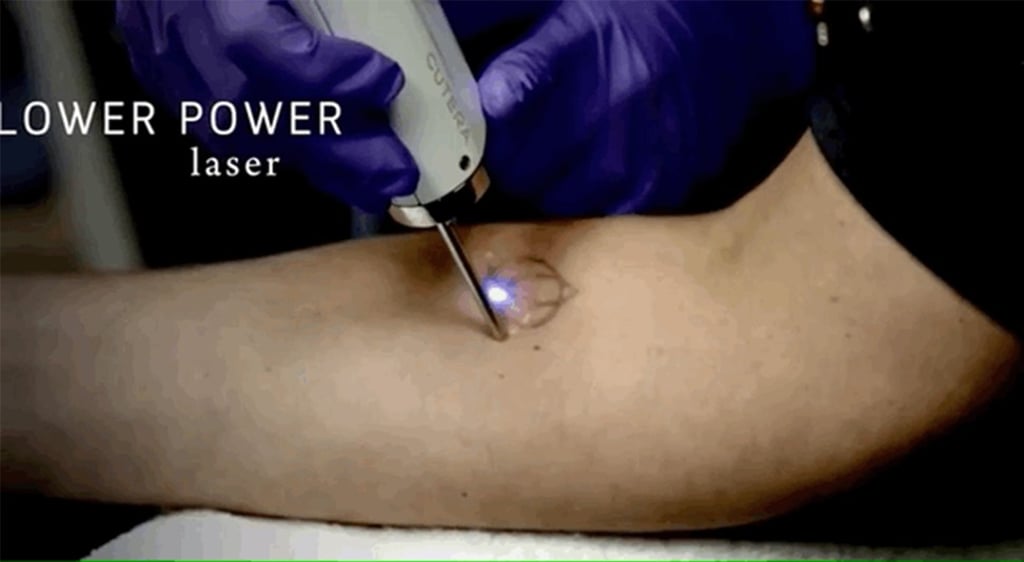Inque is a venture-backed company that has developed an erasable tattoo ink. Photo: Inque
