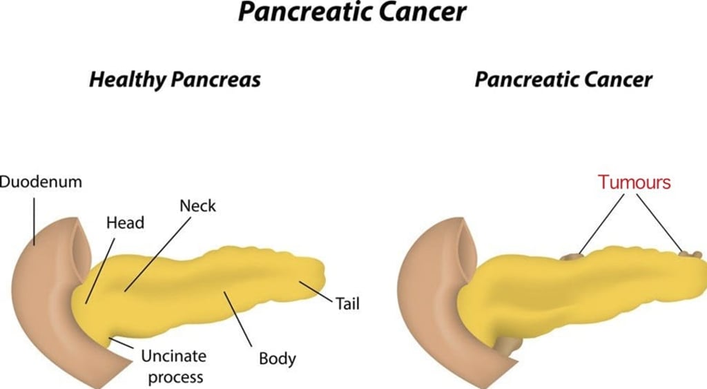 Pancreatic cancer. Illustration: Shutterstock Pancreatic cancer. Illustration: Shutterstock