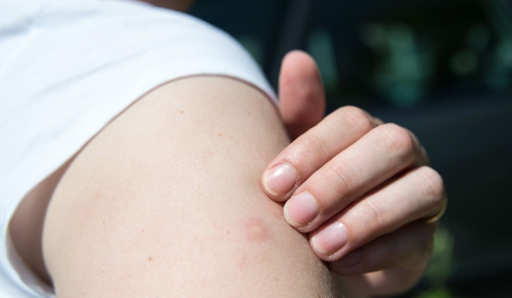 Lockdowns could have created an environment where mosquitoes are interacting more with people. Photo: DPA Lockdowns could have created an environment where mosquitoes are interacting more with people. Photo: DPA