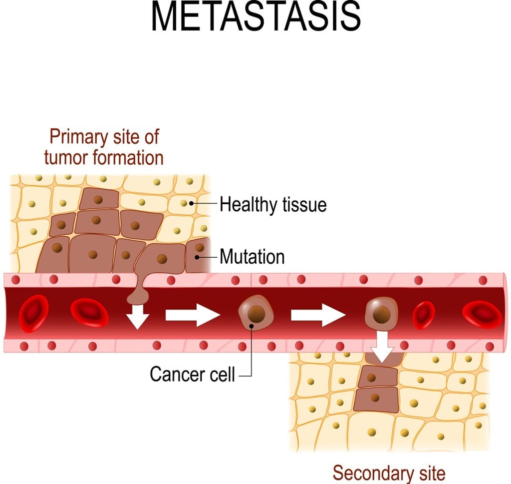 The process of metastasis. Photo: Shutterstock