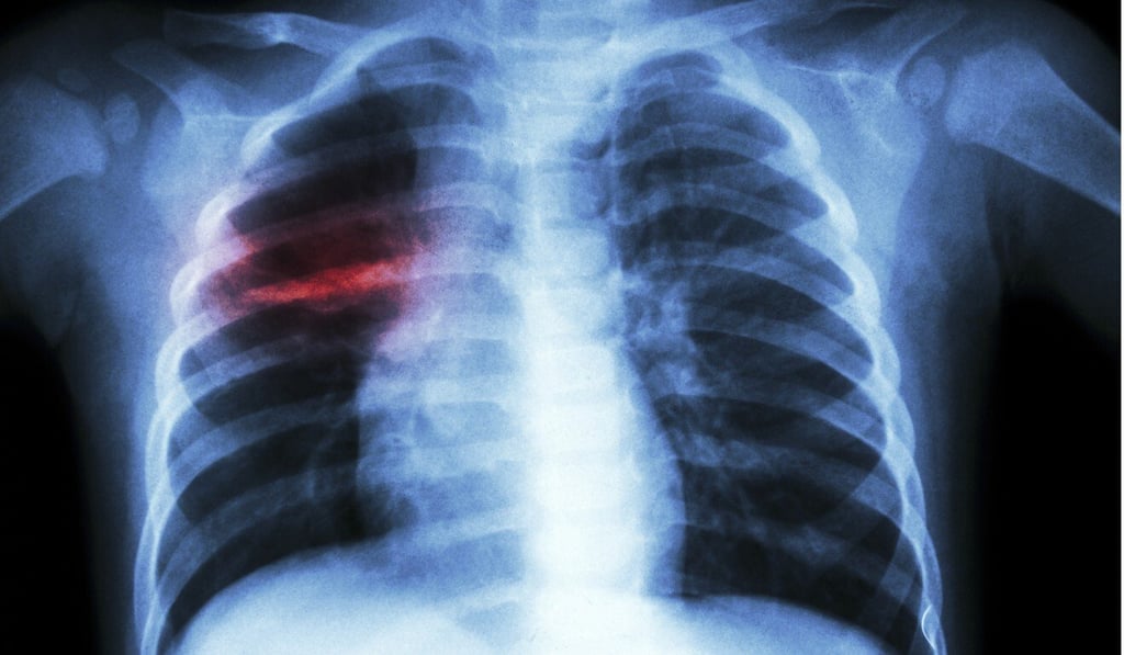A chest X-ray of a child with tuberculosis. The disease killed 1.5 million people in 2018. Photo: Shutterstock