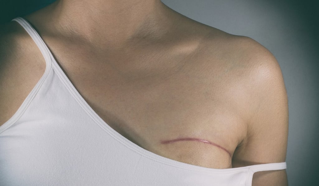 Breast cancer is the most common cancer in women in Hong Kong. Photo: TNS