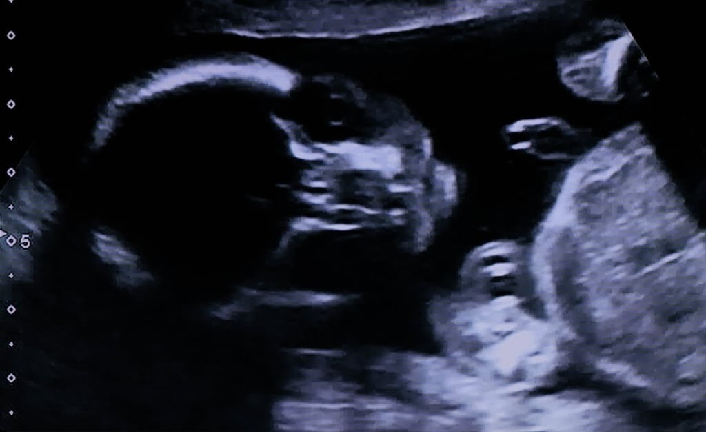 Ten to 20 per cent of pregnancies end in miscarriage, according to the Mayo Clinic of Rochester in Minnesota. Photo: Shutterstock Ten to 20 per cent of pregnancies end in miscarriage, according to the Mayo Clinic of Rochester in Minnesota. Photo: Shutterstock