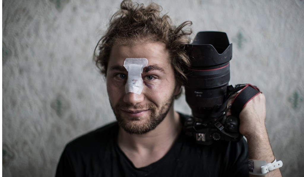 Syrian photojournalist Ameer al-Halbi was injured in the Paris protests. Photo: AFP