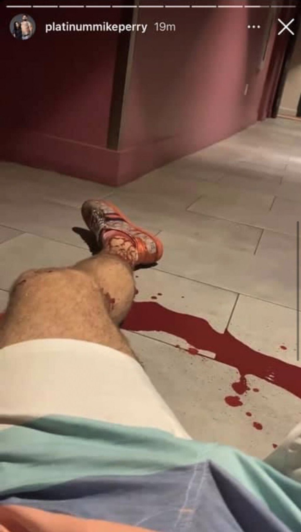 Mike Perry displays his injured left leg in a pool of blood.