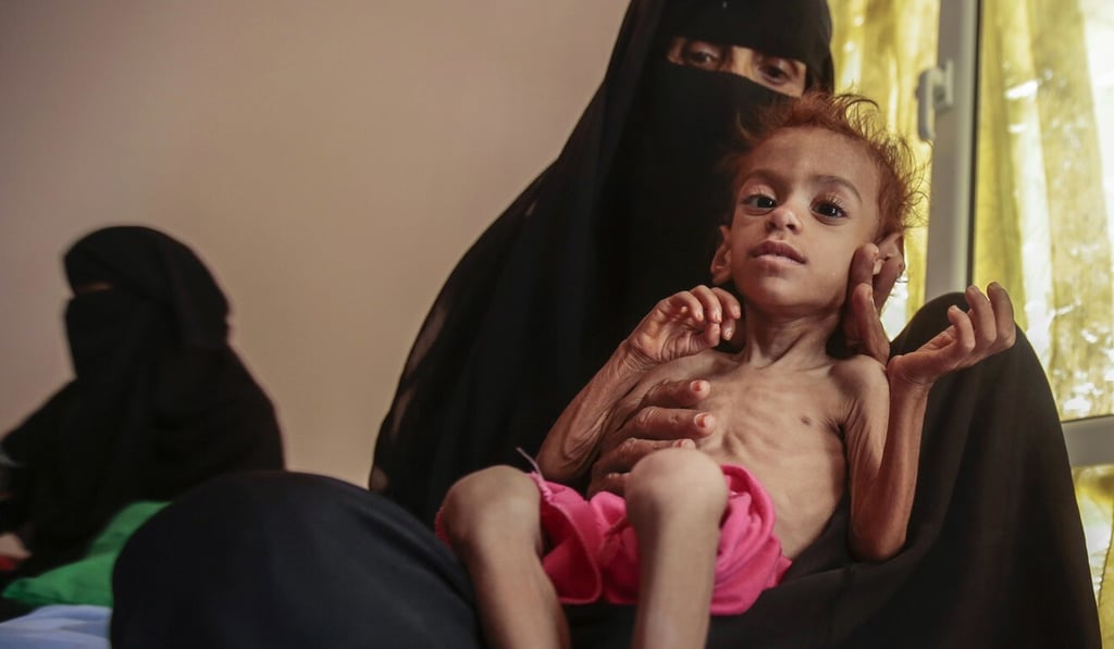 In this Oct. 1, 2018 file photo, a woman holds a malnourished boy at the Aslam Health Center, in Hajjah, Yemen. On Sunday, the UN Office for the Coordination of Humanitarian Affairs warned that more than 16 million people in Yemen would go hungry this year. Photo: AP In this Oct. 1, 2018 file photo, a woman holds a malnourished boy at the Aslam Health Center, in Hajjah, Yemen. On Sunday, the UN Office for the Coordination of Humanitarian Affairs warned that more than 16 million people in Yemen would go hungry this year. Photo: AP